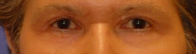 Laser EyeLid Lift Case 4075 After Photo Laser EyeLid Lift