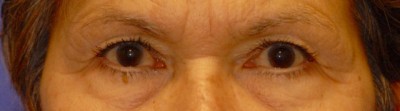 Laser EyeLid Lift Case 4075 Before Photo Laser EyeLid Lift