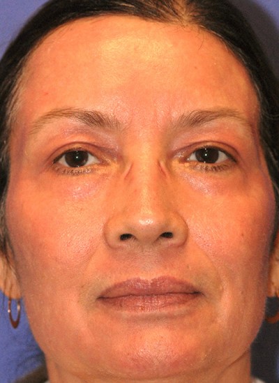 Laser EyeLid Lift Case 4087 After Photo Laser EyeLid Lift