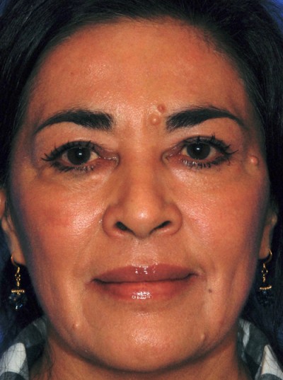 Laser Skin Resurfacing Case 4091 After Photo Laser Skin Resurfacing