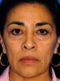 Laser Skin Resurfacing