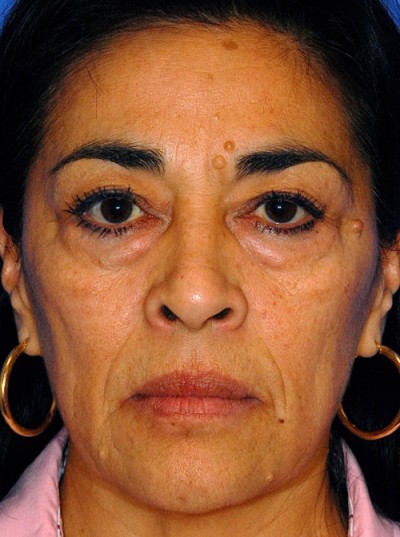 Laser Skin Resurfacing Case 4091 Before Photo Laser Skin Resurfacing
