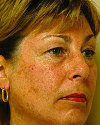 Photo Facial™ Case 4144 Before Photo Photo Facial™