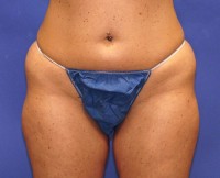 Coolsculpting