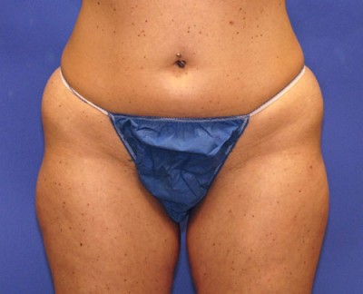 Coolsculpting