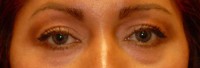 Laser EyeLid Lift