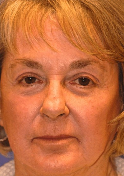 Laser Skin Resurfacing Case 4190 After Photo Laser Skin Resurfacing