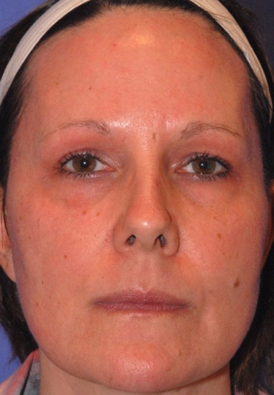 Active FX™ Laser Skin Tightening Case 4261 After Photo Active FX™ Laser Skin Tightening