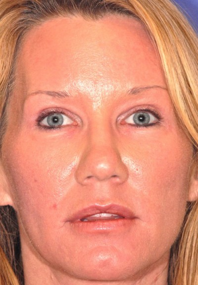 Sculptra Case 4281 After Photo Sculptra