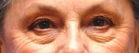 Laser EyeLid Lift