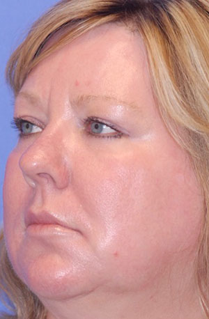 Laser EyeLid Lift Case 4364 After Photo Laser EyeLid Lift