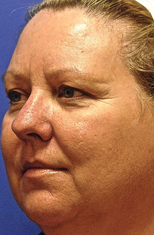 Laser EyeLid Lift Case 4364 Before Photo Laser EyeLid Lift