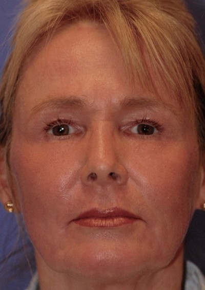 Skin Laxity Case 4368 After Photo Skin Laxity