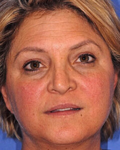 Photofacial IPL BBL treatment for rosacea and redness reduction in Scottsdale