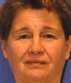 Laser EyeLid Lift Case 4458 Before Photo Laser EyeLid Lift