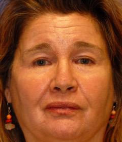 Laser EyeLid Lift Case 4458 After Photo Laser EyeLid Lift