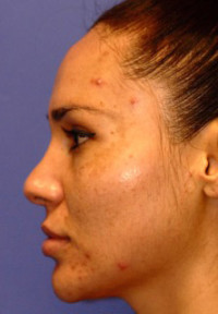 Hyperpigmentation