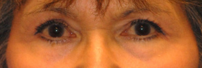 Laser EyeLid Lift Case 4583 After Photo Laser EyeLid Lift