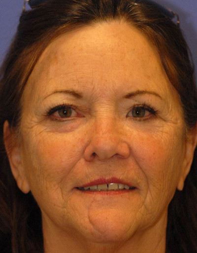 Laser Skin Resurfacing Case 4859 Before Photo Laser Skin Resurfacing