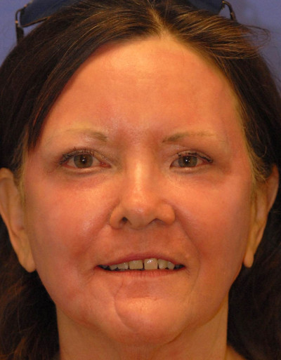 Laser Skin Resurfacing Case 4859 After Photo Laser Skin Resurfacing