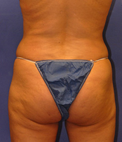 Profound RF Case 5065 Before Photo Profound RF