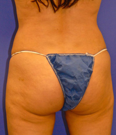 Profound RF Case 5065 After Photo Profound RF