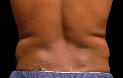 Coolsculpting Case 5080 Before Photo Coolsculpting