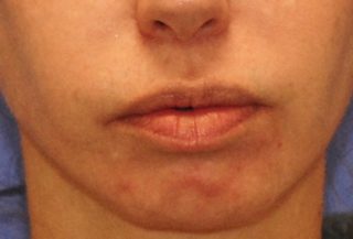 Lip Fillers