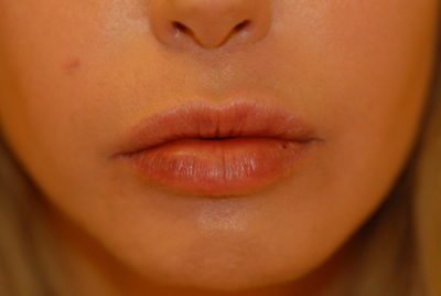 Lip Fillers