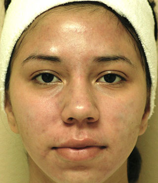 Acne & Acne Scar Laser Treatment