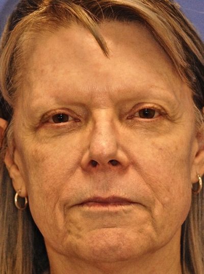 MaxFX CO2 Laser Resurfacing Case 5233 Before Photo MaxFX CO2 Laser Resurfacing