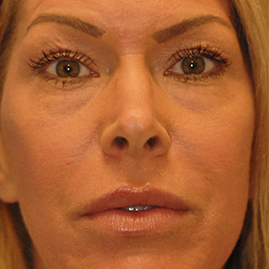 Laser Skin Resurfacing