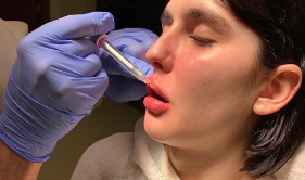 Lip Injection