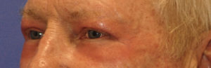 Man with less wrinkles, Laser Resurfacing, Scottsdale AZ