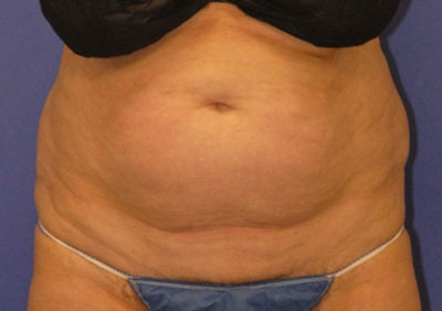 Coolsculpting Case 5453 Before Photo Coolsculpting