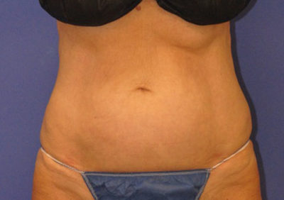 Coolsculpting Case 5453 After Photo Coolsculpting