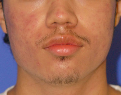 Acne & Acne Scar Laser Treatment Case 5525 After Photo Acne & Acne Scar Laser Treatment