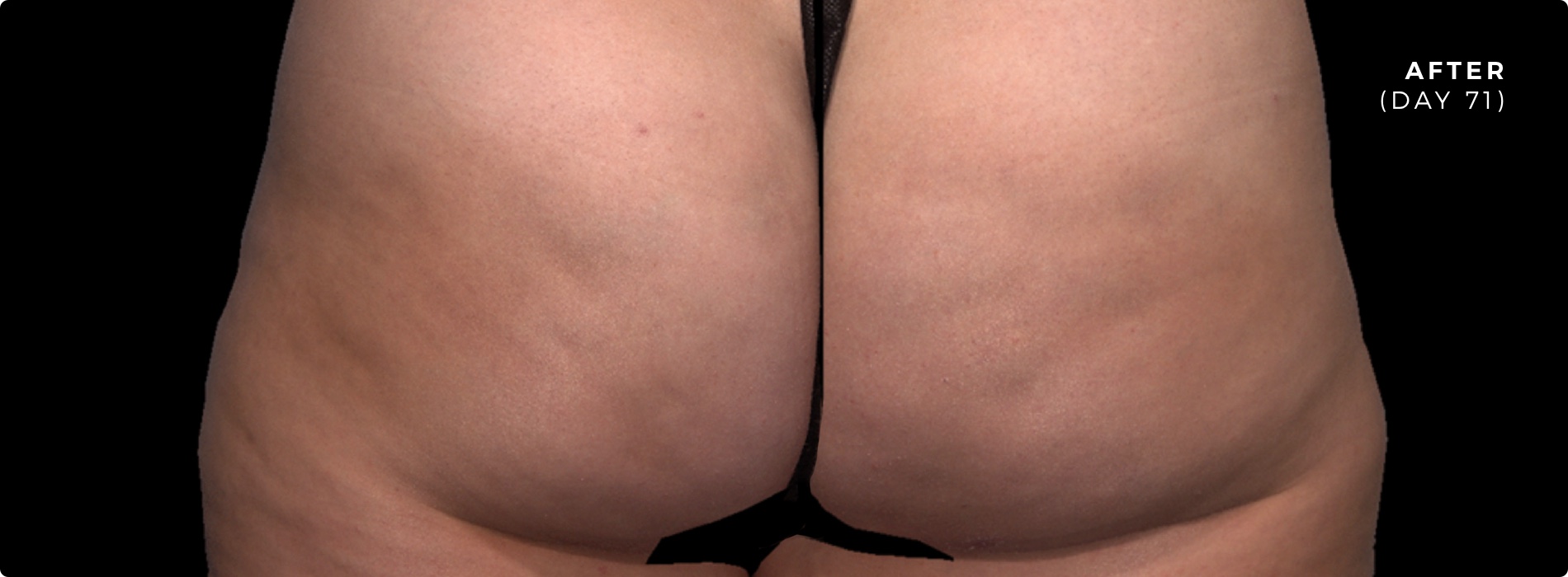 QWO After Treatment Photo QWO After Treatment Photo