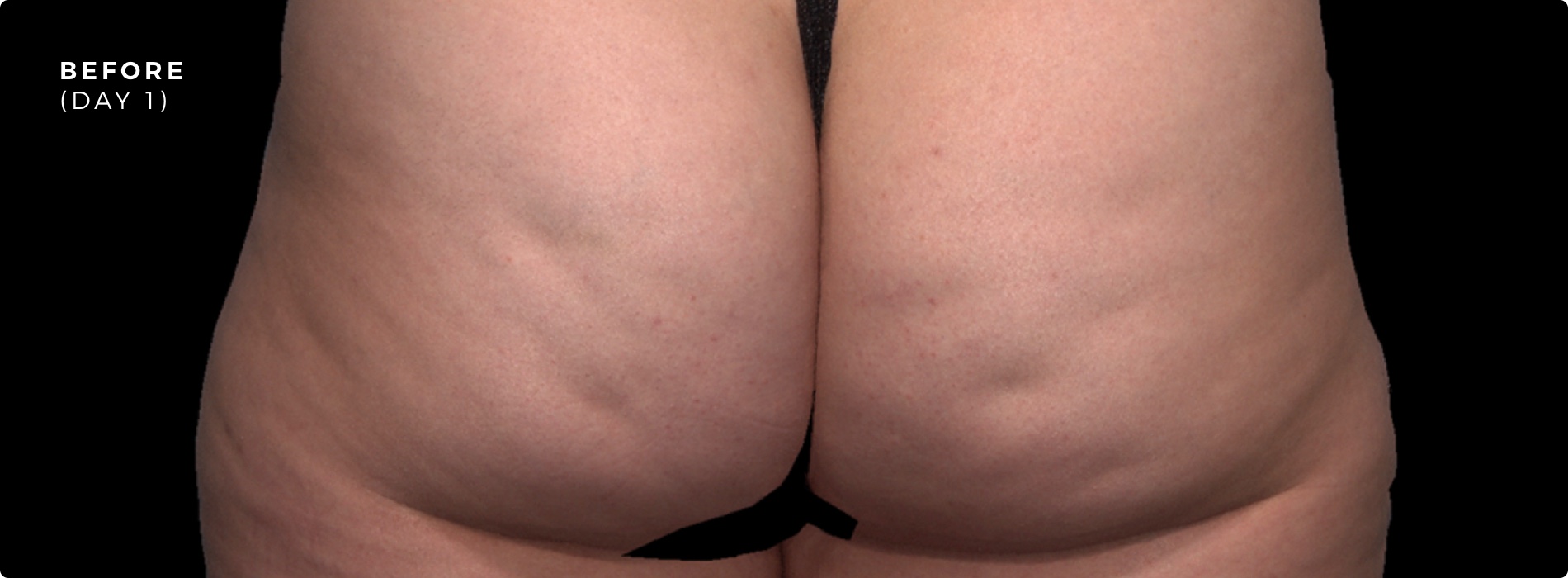 QWO Before Treatment Photo QWO Before Treatment Photo