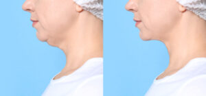 before and after ultherapy