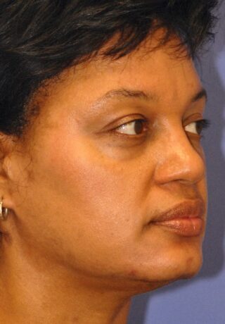 Melasma