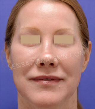 MaxFX CO2 Laser Resurfacing