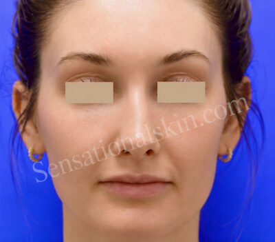 Photo Facial™