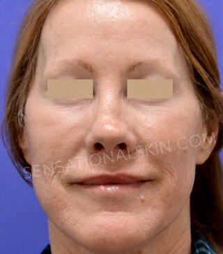 MaxFX CO2 Laser Resurfacing