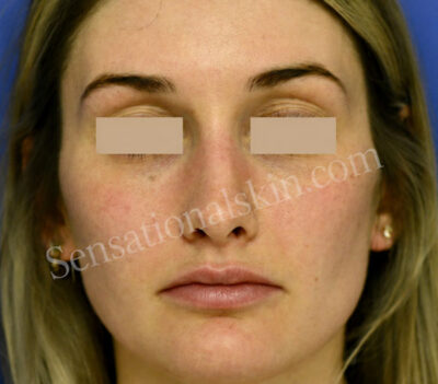 Photo Facial™