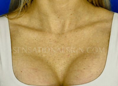 Photo Facial™
