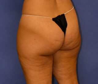 VelaShape