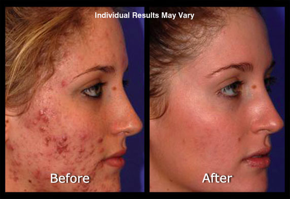 Acne Laser Treatment Before & After Scottsdale