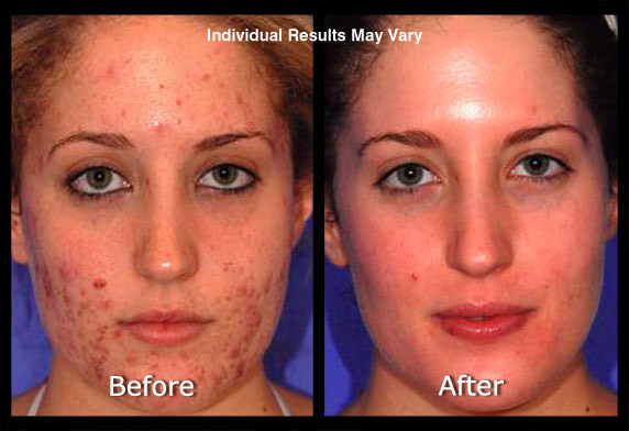 Acne Laser Treatment Before & After Scottsdale