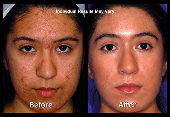 Acne Laser Treatment Before & After Scottsdale